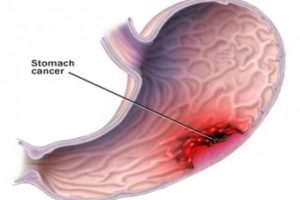 Illustration showing where cancer is in a stomach